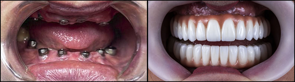 Profesjonalne implanty zębów Rybnik
